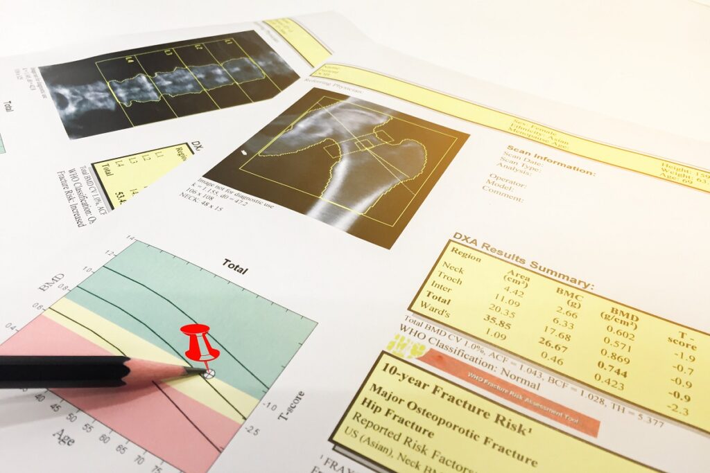osteoporosi osteoporosi