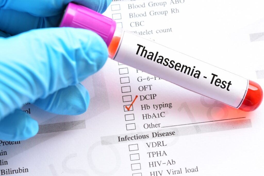 Talassemia Talassemia