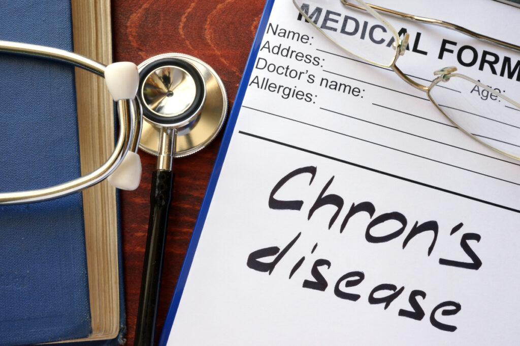 Ileite terminale o Morbo di Crohn Ileite terminale o Morbo di Crohn