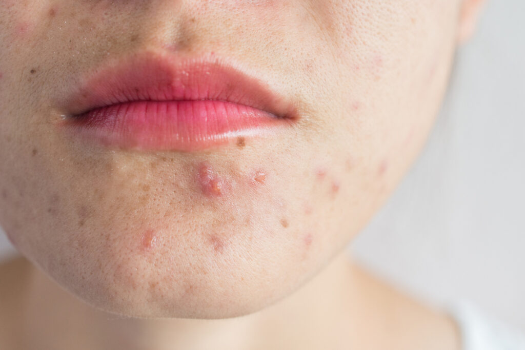 acne-dermopatia-seborroica acne-dermopatia-seborroica