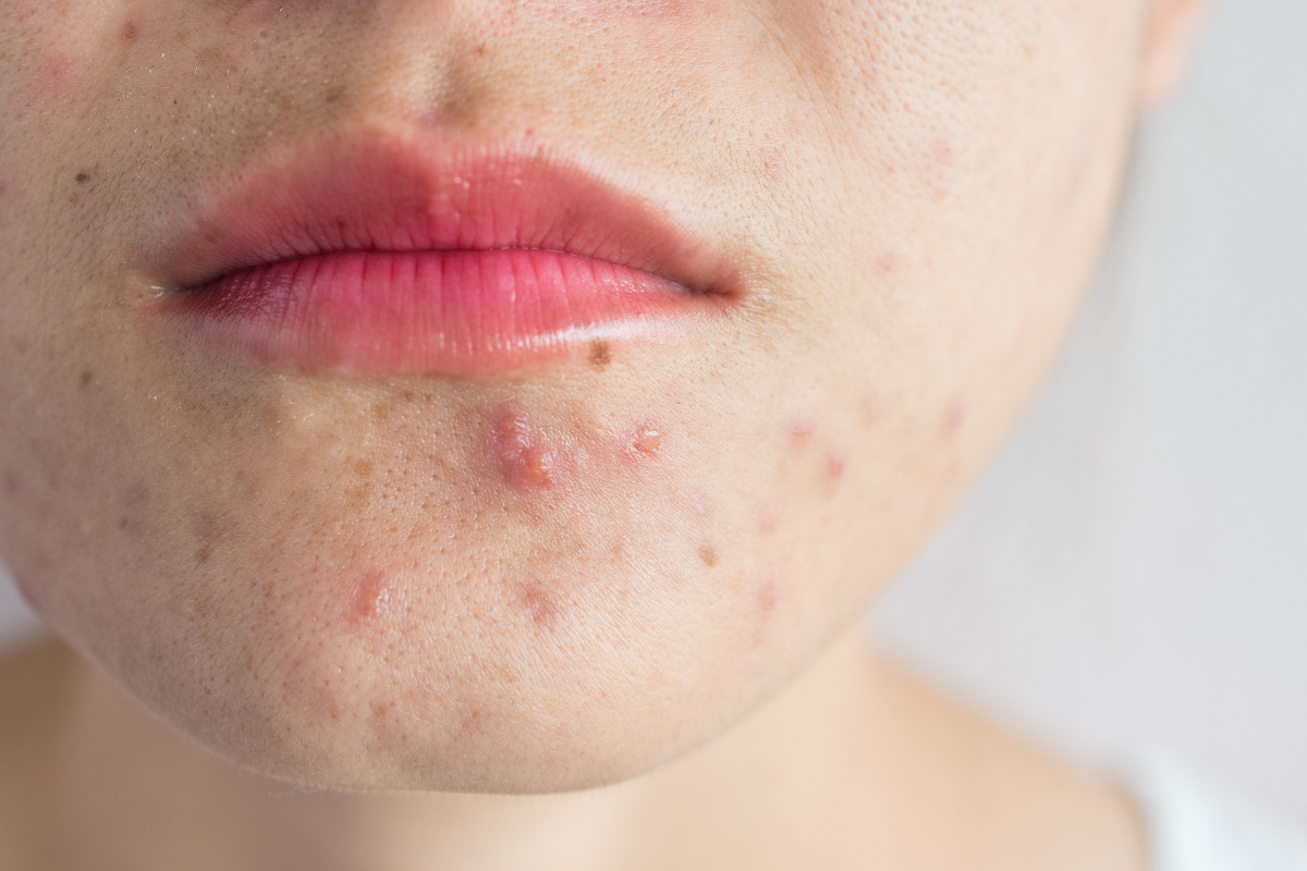 acne-dermopatia-seborroica acne-dermopatia-seborroica