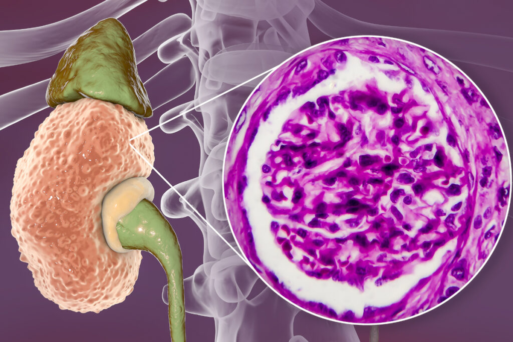glomerulonefrite-cronica-con-protenuria glomerulonefrite-cronica-con-protenuria