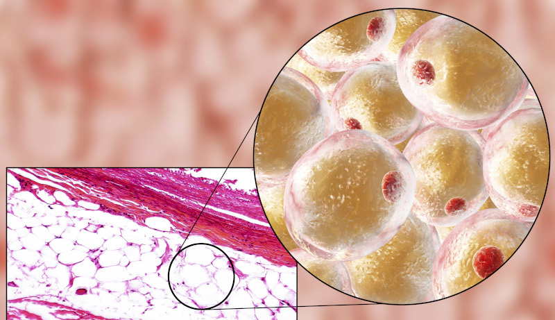 Obesità, non è solo accumulo di grasso