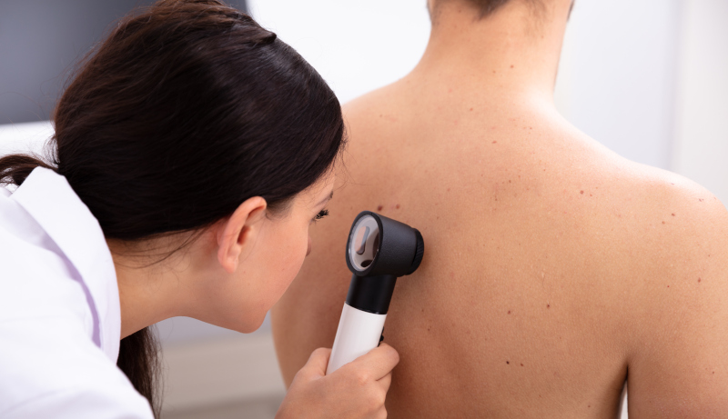 Dieta e melanoma